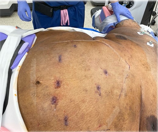 Immediate postoperative view.