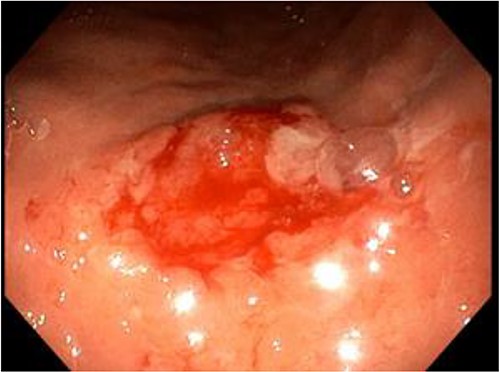 A small, raised ulcer measuring ~2 cm in diameter. Redness, irregular shape with an everted edge.