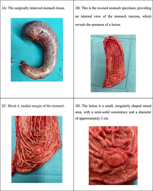 (A) The surgically removed stomach tissue. (B) This is the excised stomach specimen, providing an internal view of the stomach mucosa, which reveals the presence of a lesion. (C) Block 4, medial margin of the stomach. (D) The lesion is a small, irregularly shaped raised area, with a semi-solid consistency and a diameter of ~2 cm.