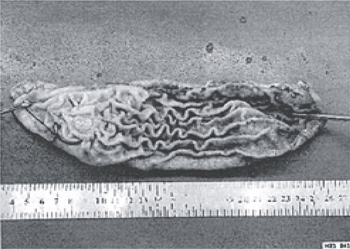 The excised stomach sample was dispatched for pathological examination.