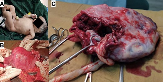 Live newborn after prolonged abdominal pregnancy (A), placenta adhesions to the left annex of the uterus (B), and adnexectomy (C).