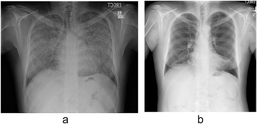 (a) Chest radiograph shows extensive calcification all over both lungs’ fields. (b) Chest radiograph after the transplant.
