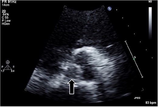 Transthoracic echocardiography in the parasternal short-axis view revealing a hypo- or iso-echoic mass (arrow; ~1 cm in diameter) on the noncoronary cusp of the aortic valve.