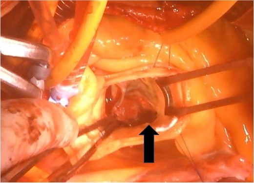 A 2 × 2-cm vegetation is observed on the noncoronary cusp of the aortic valve.
