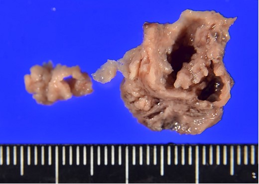 Gross appearance of the resected vegetation.