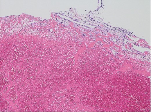 Histopathological appearance of the vegetation: mainly fresh and organizing thrombus, consisting of fibroblast and capillary hyperplasia in the upper part of the specimen (hematoxylin and eosin staining, ×100).
