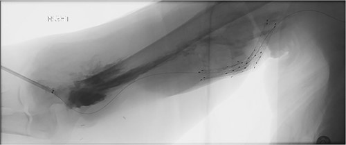 Fistulogram demonstrating contrast extravasation around the sheath access site.