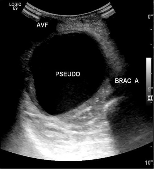 Duplex ultrasound of brachial artery pseudoaneurysm.