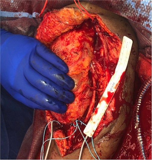 20 × 35 cm brachial artery pseudoaneurysm.