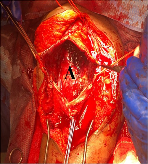 Decompression of giant brachial artery pseudoaneurysm.
