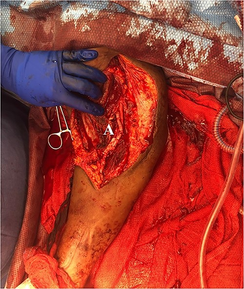 Completed patch angioplasty of brachial artery (A).
