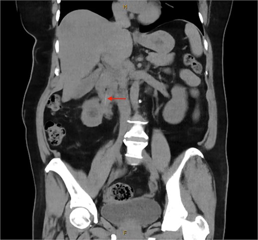 Unenhanced computed tomography of the abdomen and pelvis demonstrating a 5 cm linear radiopaque foreign body extending from the junction of the first and second part of the duodenum into the right renal pelvis.