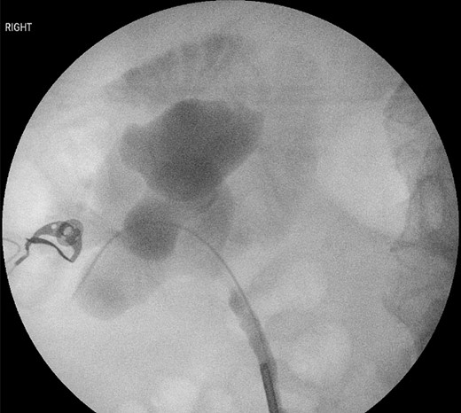 Retrograde pyelogram demonstrating contrast extravasating from the right renal pelvis into the duodenum.