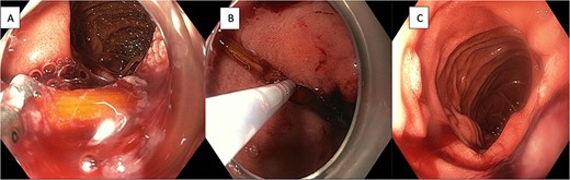 (A) Endoscopic view of toothpick lodged in the wall of the duodenum at the junction of first and second parts. (B) Endoscopic retrieval of the toothpick with through-the-scope snare. (C) Endoscopic view of second part of duodenum following retrieval of foreign body.