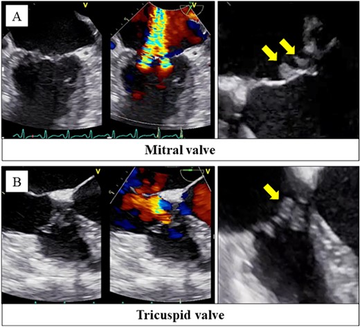 Transesophageal echocardiography revealed severe mitral regurgitation and tricuspid regurgitation with mobile vegetations on both valves (A, B).