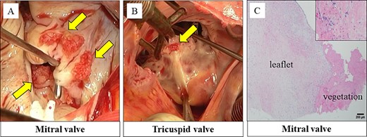 Vegetations were observed on the anterior and posterior leaflet of the mitral valve (A). Vegetations were also observed on the anterior and septal leaflet of the tricuspid valve (B). Histopathological findings: the vegetations on the mitral and tricuspid valves consisted of fibrin and platelets. No bacterial colonies were detected (C).