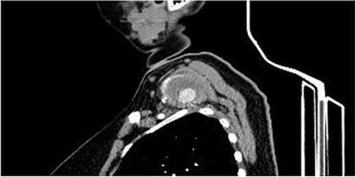 CTA, sagittal view showing the left supraclavicular pseudoaneurysm 4 × 3 cm.