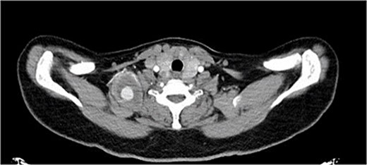 CTA, axial view showing the pseudoaneurysm.