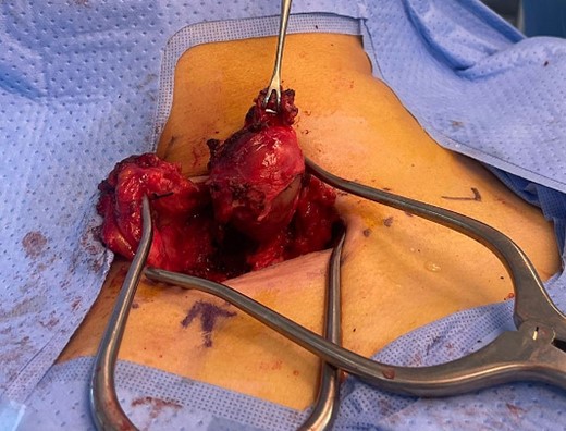 The supraclavicular incision and well-capsulated pseudoaneurysm with scalene muscle fully dissected intraoperatively.