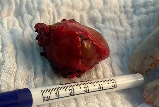 The pseudoaneurysm post resection.