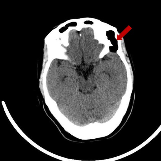 Pre-operative axial CT scan displaying a well-defined, low attenuating lesion in the left fronto-zygomatic region.