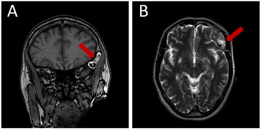 Pre-operative brain MRI exhibiting: (A) a high-intensity lesion in the left fronto-zygomatic region on coronal T1-weighted images (T1WI), and (B) Axial T2-weighted images (T2WI) depicting variable signal intensity ranging from iso- to hyperintense.