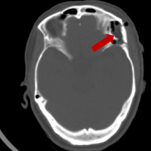 Post-operative brain axial CT scan illustrating the total resection of the lesion.