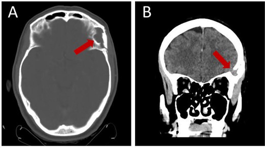 Follow-up brain CT, 3 months post-operation, showing complete resection of the lesion without residual tissue: (A) axial view and (B) coronal view.