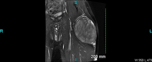 MRI Coronal view of L Leg.