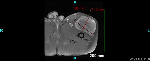 MRI Axial view of L Leg.
