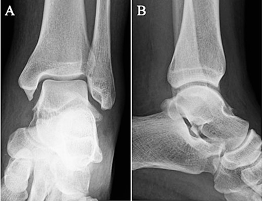 Plain radiographs of the left ankle showed no abnormal findings in the anteroposterior (A) view, but a fracture line was discovered at the base of the lateral process of the talus in the lateral (B) view.