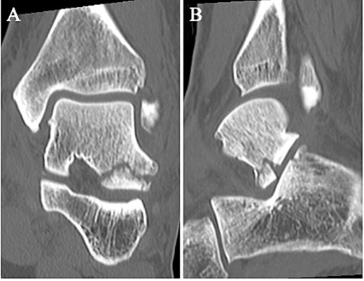 Non-contrast CT showed a simple fracture line that extending from the talofibular articular surface down to the posterior talocalcaneal articular surface of the subtalar joint in the coronal (A) and sagittal (B) views.
