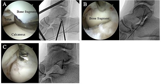 (A) A 30° arthroscope with a diameter of 2.7 mm was used to observe the fracture site. (B) The bone fragment was reduced using a guidewire sleeve and fixed with a 0.8-mm guidewire. (C) The fragment was fixed through the guidewire with a cannulated double-threaded screw.