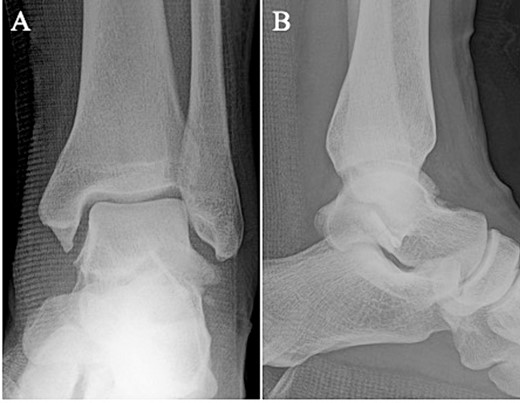 Postoperative plain radiographs showed that the bone fragment was fixed in the correct position in the anteroposterior (A) and lateral (B) views.