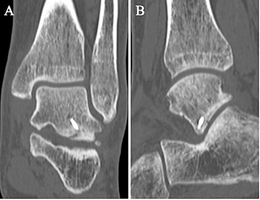 A non-contrast CT taken at 12 weeks postoperatively showed bone union in the coronal (A) and sagittal (B) views.