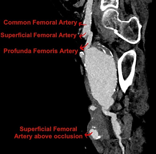 Reconstructed sagittal view of the CT angiogram lower limb showing the PFAA.