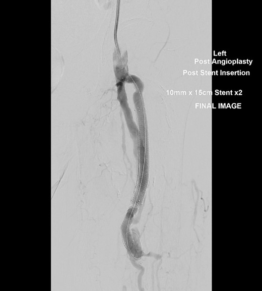 Conventional angiogram of the left PFA showing exclusion of the aneurysm and flow into the distal PFA after deployment of a second 10 mm × 150 mm Viabahn stent.