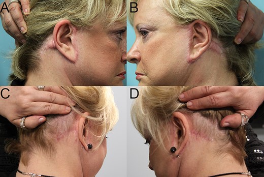 Bilateral cervical and preauricular keloids. Pre- (A and B) and post-operative 4 years (C and D) pictures after keloid excision, reconstruction with redo facelift, and postoperative radiotherapy.