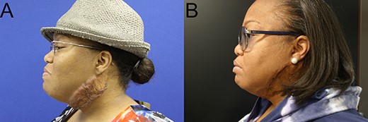 Cervical keloids. Pre- (A) and post-operative 9 years (B) pictures after keloid excision, reconstruction with FTSG, and postoperative radiotherapy.