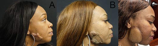 Recalcitrant cervical keloids. Pre- (A) and postoperative 4 years (B) pictures after keloid excision, reconstruction with FTSG. Postoperative 6 months (C) pictures after second keloid excision, reconstruction with SCIP free flap.