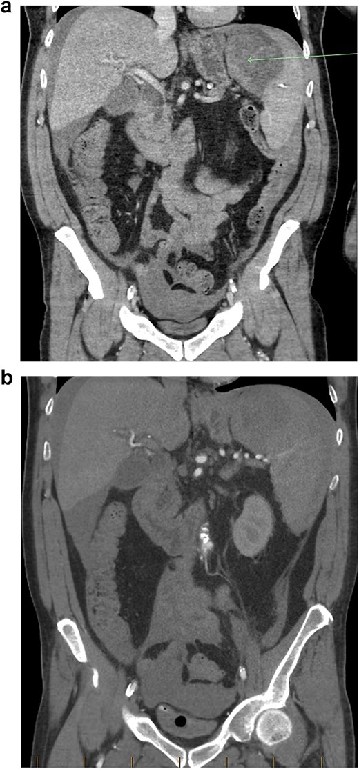 (a) Coronal view of CT-abdomen/pelvis in the portal venous phase showing moderate volume free-fluid/blood around the liver, both paracolic gutters, extending to the lower abdomen and pelvis. There is a large haematoma seen within or adjacent to the spleen (arrow). (b) Coronal view of CT-abdomen/pelvis angiogram redemonstrating the known splenic haematoma, however there was no evidence of active arterial contrast extravasation.