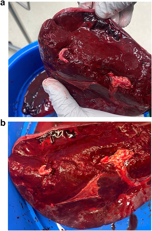 (a, b) Intraoperative specimen showing a large capsular tear with a large haematoma.
