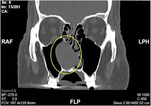 Coronal View of right nasal mass.