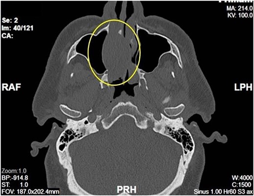 Axial View of right nasal mass.