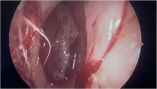 Intraoperative image showing intranasal mass.