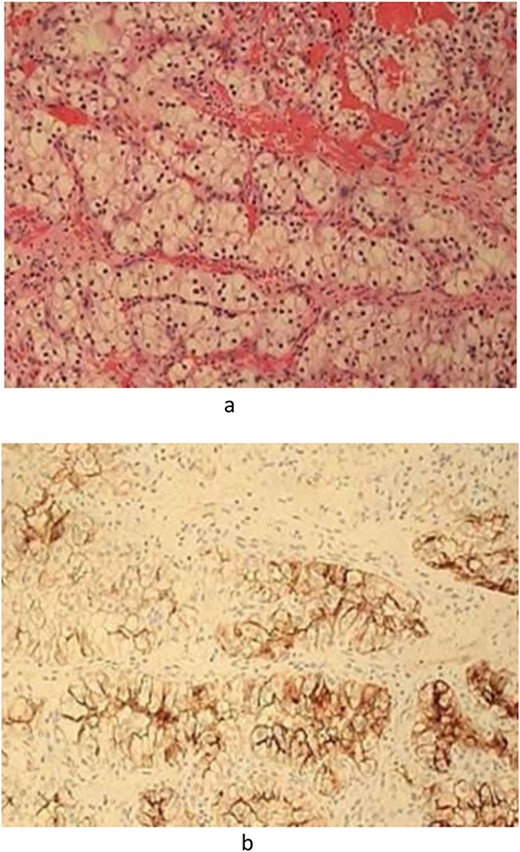 (a) Pathology—Hematoxylin and Eosin-stained section demonstrated fragments of soft tissue with blood representing clear cell malignant population. (b). Pathology—Immunohistochemistry including Cytokeratin AE1/AE3, CD10, RCC, and vimentin were strongly positive.