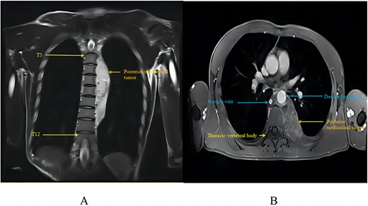 Posterior mediastinal haemangioma as seen on chest MRI: (A) tumour in MRI coronal view; (B) tumour in MRI axial view.