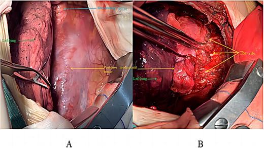 Intraoperative surgical procedure: (A) before tumour excision; (B) during tumour mobilization.