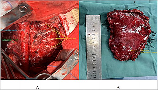 Post-resection surgical view: (A) view after tumour resection; (B) excised tumour specimen.