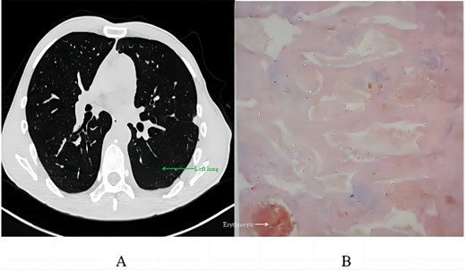 Postoperative analysis: (A) chest CT scan 2 months post-discharge; (B) pathological section.